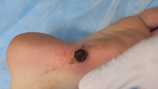 Удаление Подошвенной Бородавки с Мозолью (Тирасполь и Бендеры)