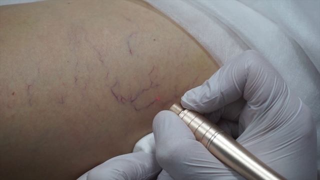 Удаление Общирной Сосудистой Сетки На Ноге