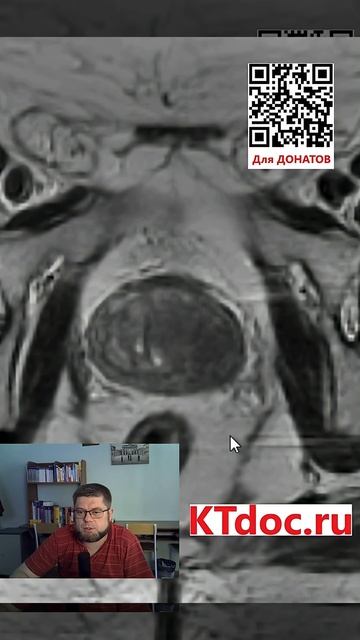 Предстательная железа на МРТ #mentor #ct #кт #наставник #мрт #mri #mentor #наставник  #ktdoc #ктдок