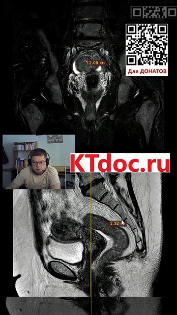 Опухоль кишки на МРТ #mentor #ct #кт #наставник #мрт #mri #mentor #наставник  #ktdoc #ктдок