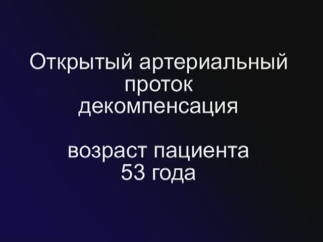 ОАП декомпенсация 53 года