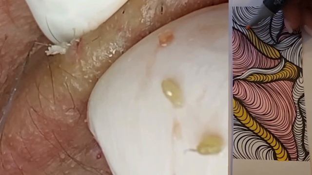 Механическая чистка лица
