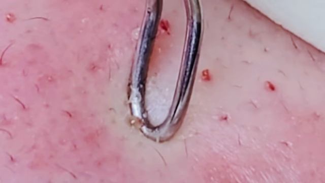 Чистка лица от прыщей и черных точек