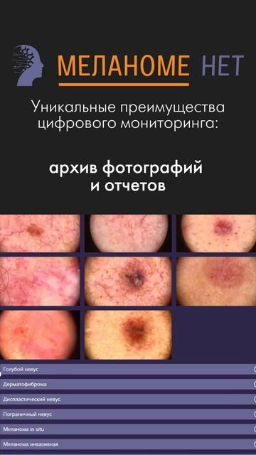 Точность и качество — стандарт современной диагностики с Меланоме нет