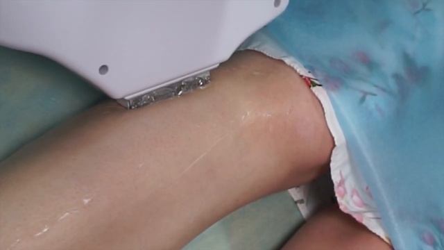 Когда Выпадут Волосы После Лазерной Эпиляции _