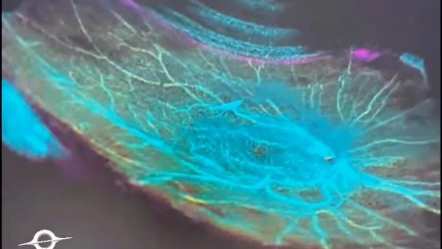 Неоваскуляризация в 3D, пролиферативная диабетическая ретинопатия