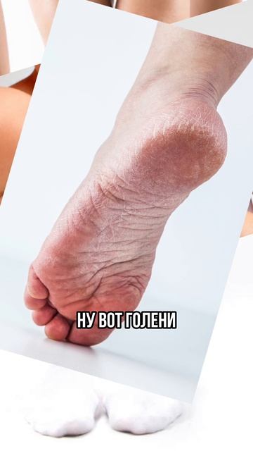 Сухие голени - проверьте щитовидку.