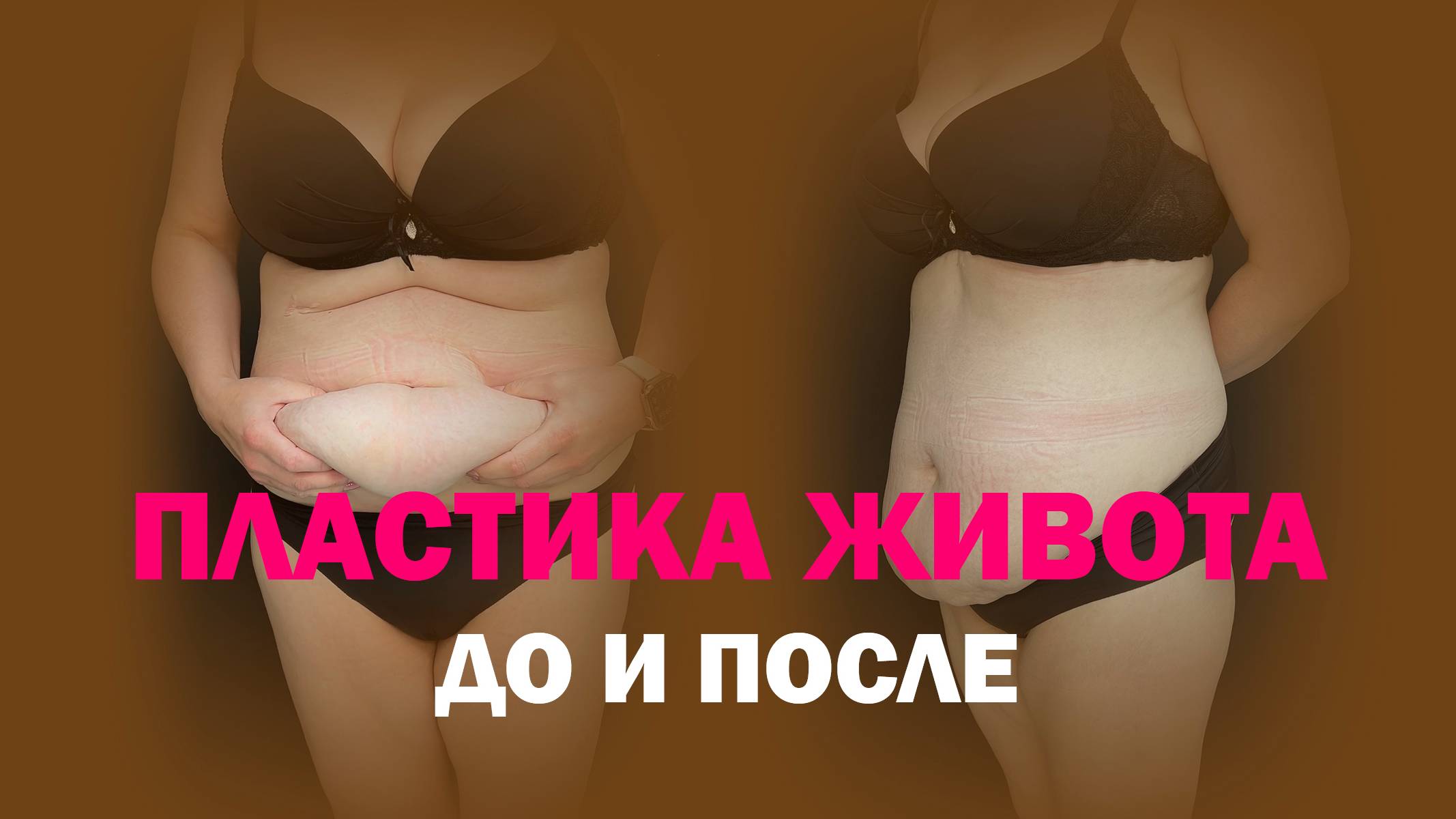 Липоабдоминопластика: минус фартук, плюс уверенность
