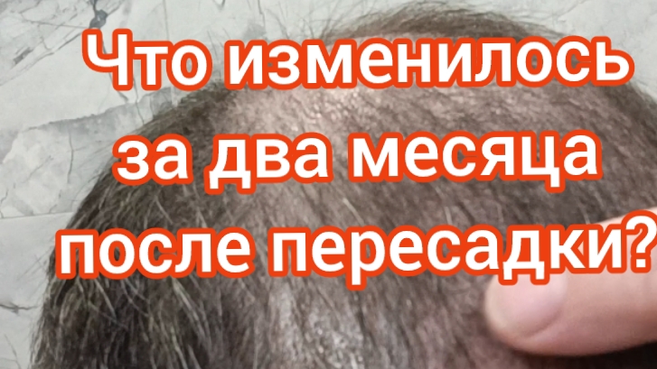 Пересадка волос. Два месяца после пересадки! Что случилось?
