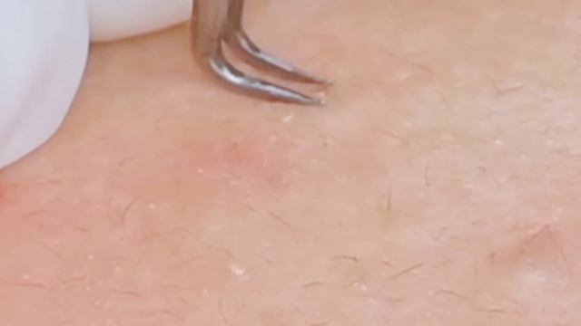Чистка лица от прыщей и черных точек