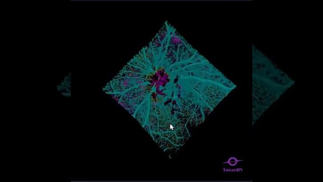 Cосуд NVD (неоваскуляризация диска) в 3D зафиксированный с помощью ОКТ TowardPi BMizar