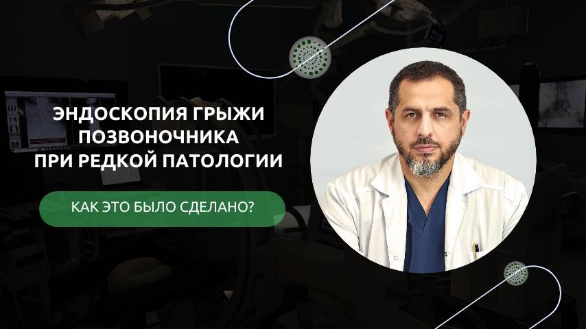 ЭКСТРАФОРАМИНАЛЬНАЯ КОМПРЕССИЯ || Возможности монопортальной эндоскопической хирургии