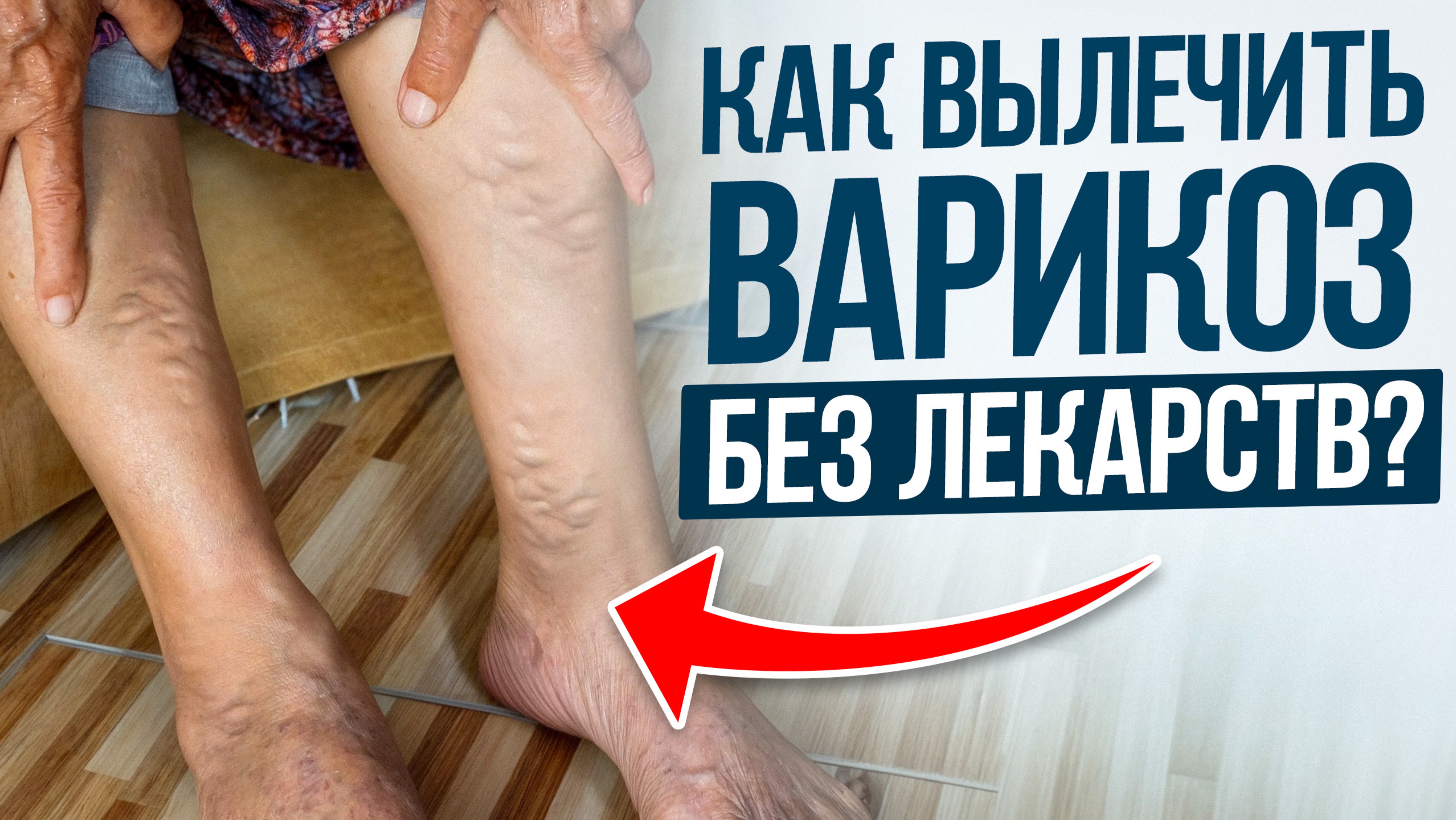 ИЗБАВЬСЯ от ВАРИКОЗА раз и НАВСЕГДА! / Первопричины и метод борьбы с расширением вен