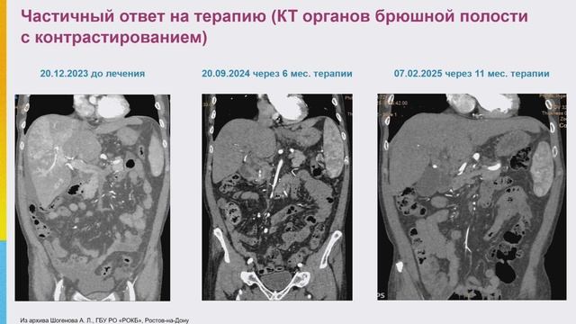 На приеме коморбидный пациент с распространенным ГЦР