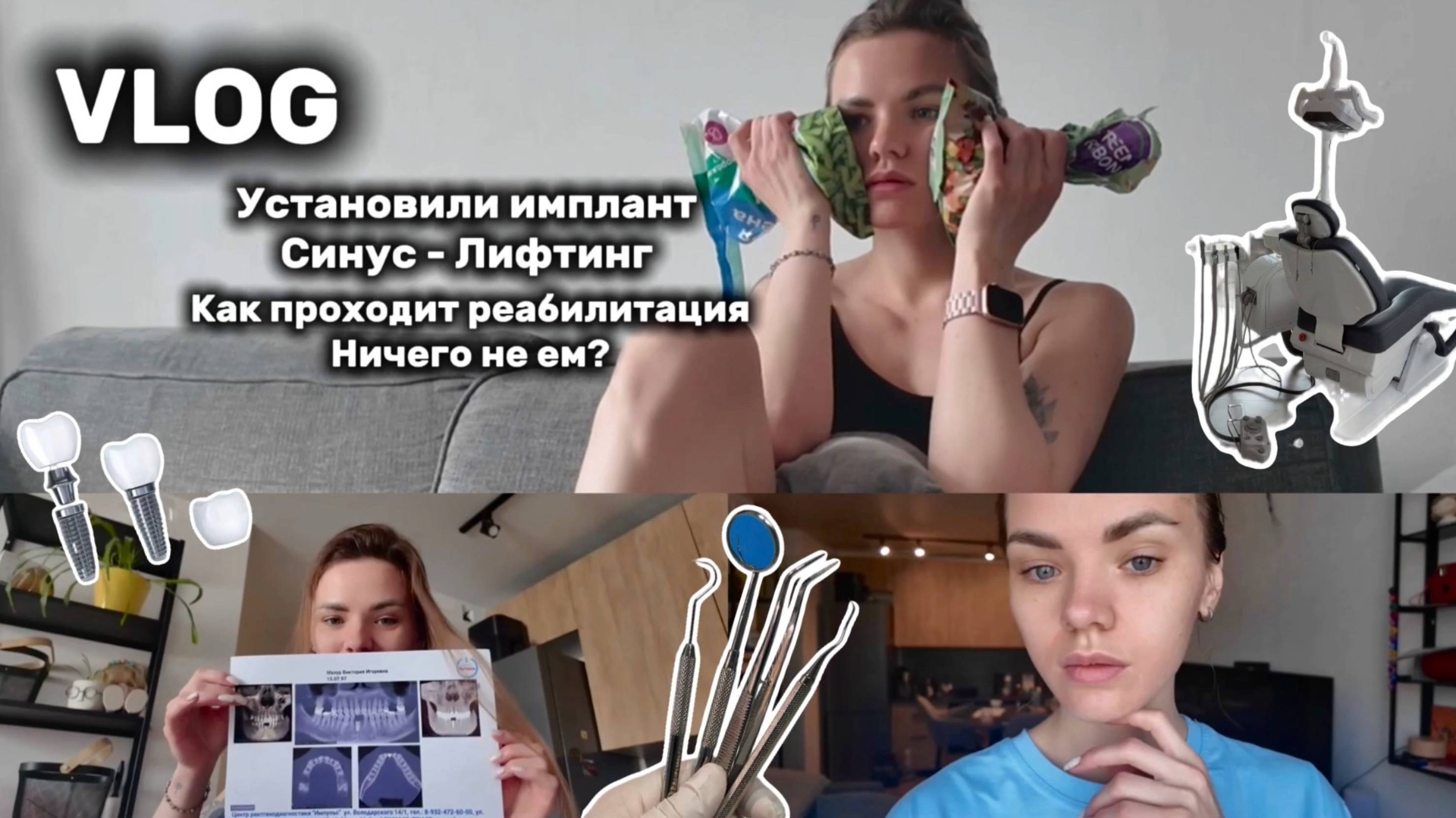 VLOG//Синус-Лифтинг что это?//Установили Импланты//Было больно?//Реабилитация первые дни//Что я ем//