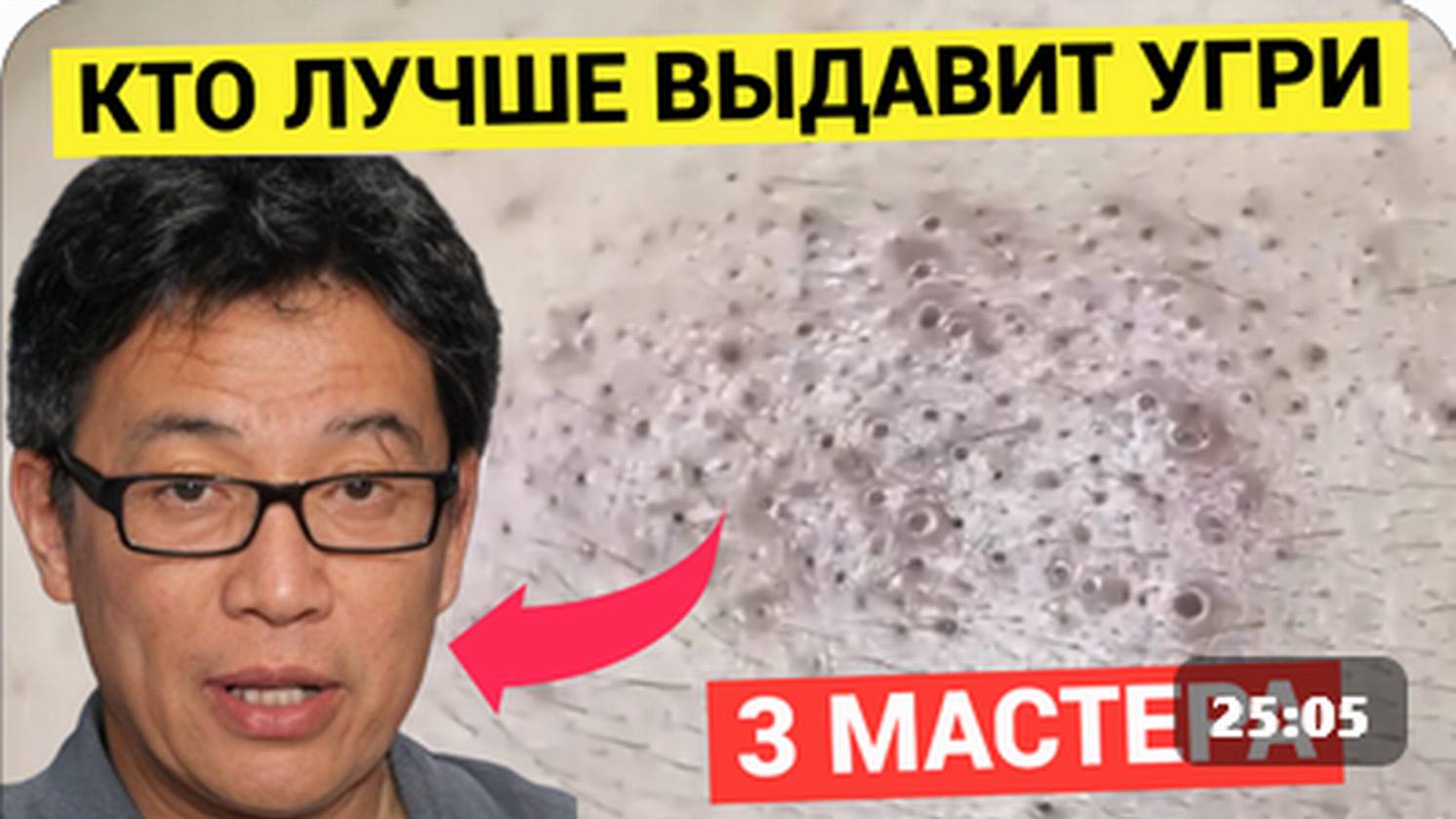 Кто Лучше Выдавит Прыщи и Угри. 3 Косметолога соревнуются в очистке Кожи Лица от Комедонов и Черных