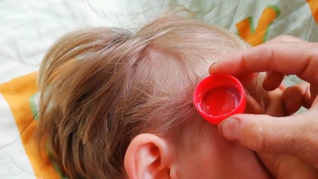 #клещ #укусилклещ  Как  быстро и легко удалить клеща, самый безопасный способ!