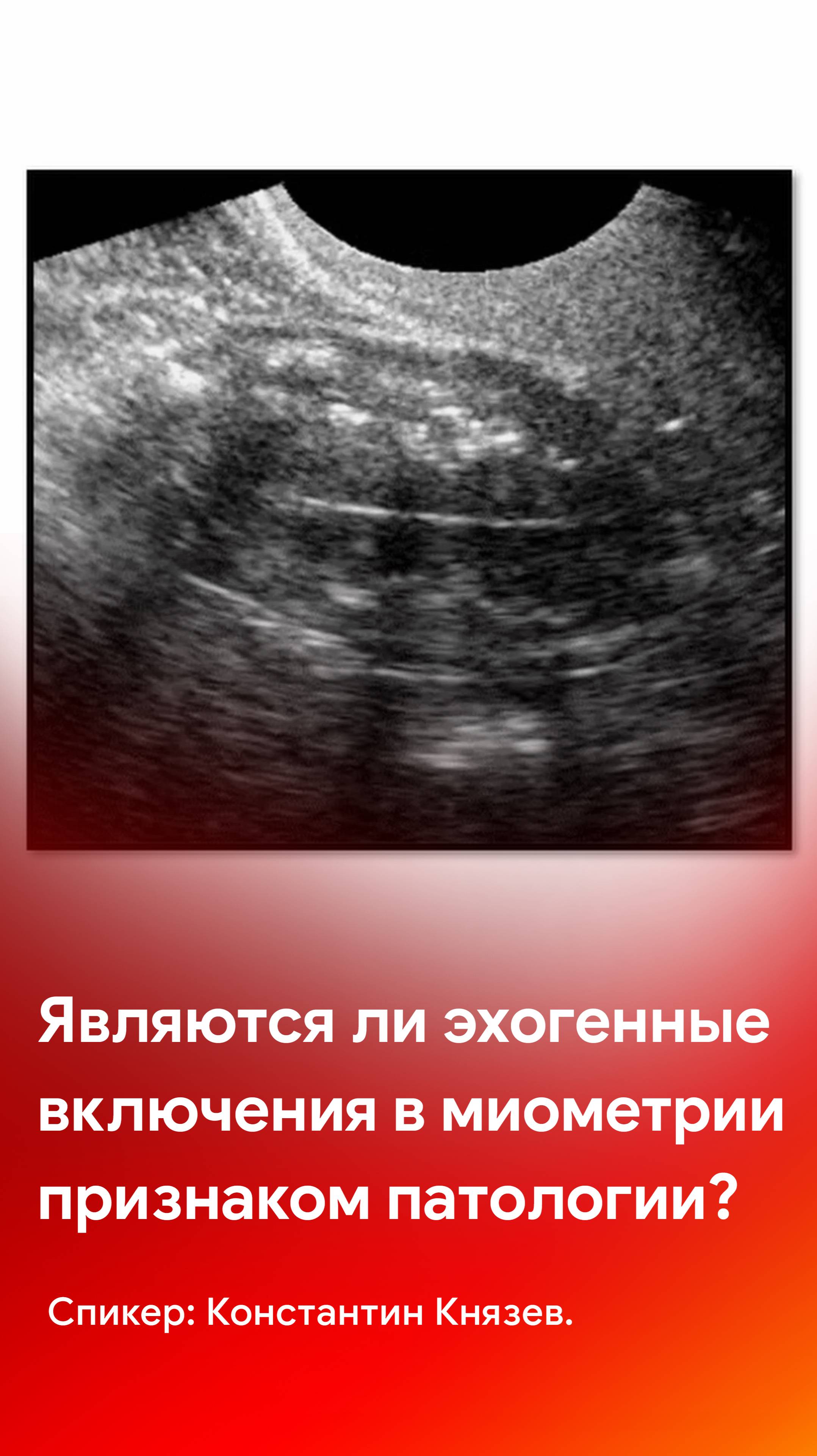 УЗИ в гинекологии: являются ли эхогенные включения в миометрии признаком патологии?
