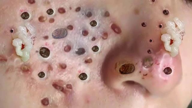Давим множество угрей и чёрных точек. кайф