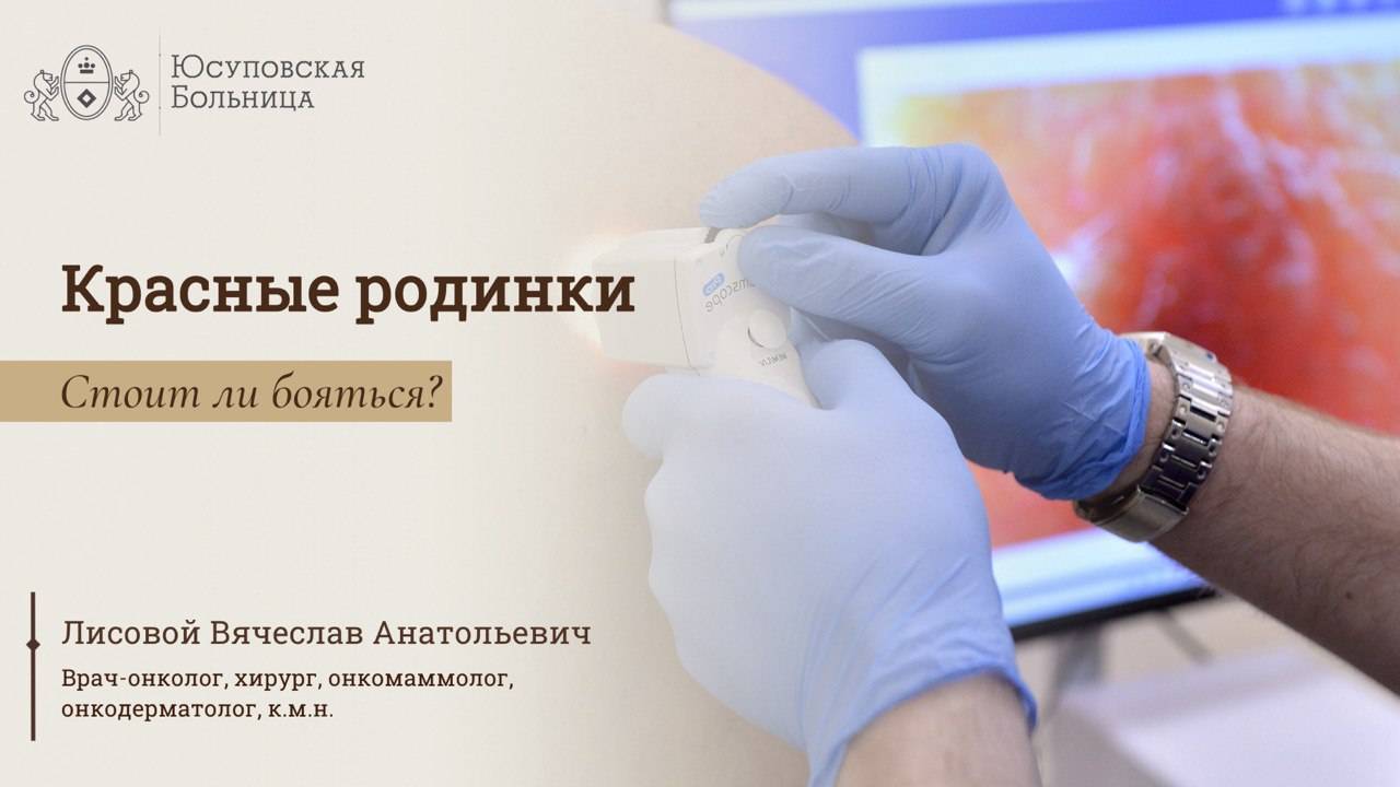 Родинки: какие опасны? Обследование в Юсуповской Больнице