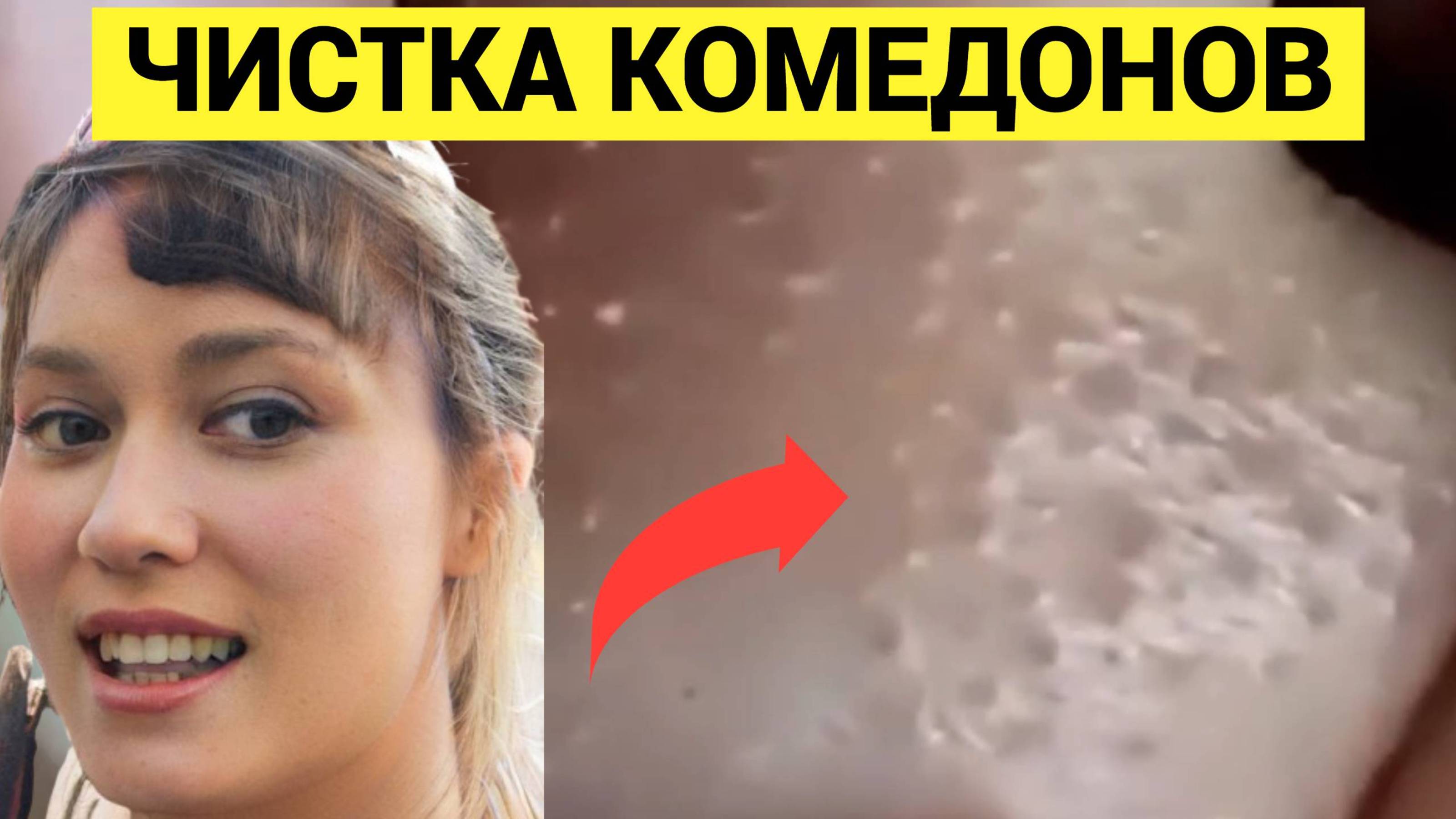 Черные Точки и Комедоны ОРИГИНАЛЬНО выдавливаются Липкой Лентой! #прыщи