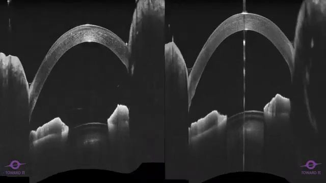 Эпителиальный врост до и после фототерапевтической кератэктомии на снимках ОКТ TowardPi