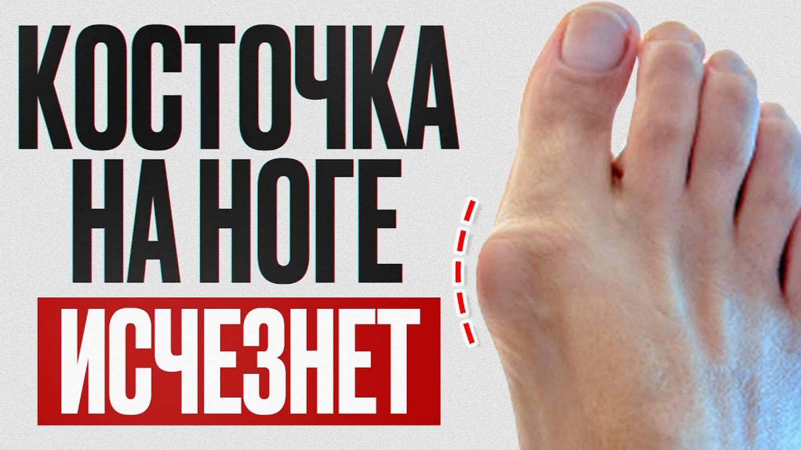 Шишка на большом пальце уйдет НАВСЕГДА! Упражнения и рекомендации для устранения «косточки»
