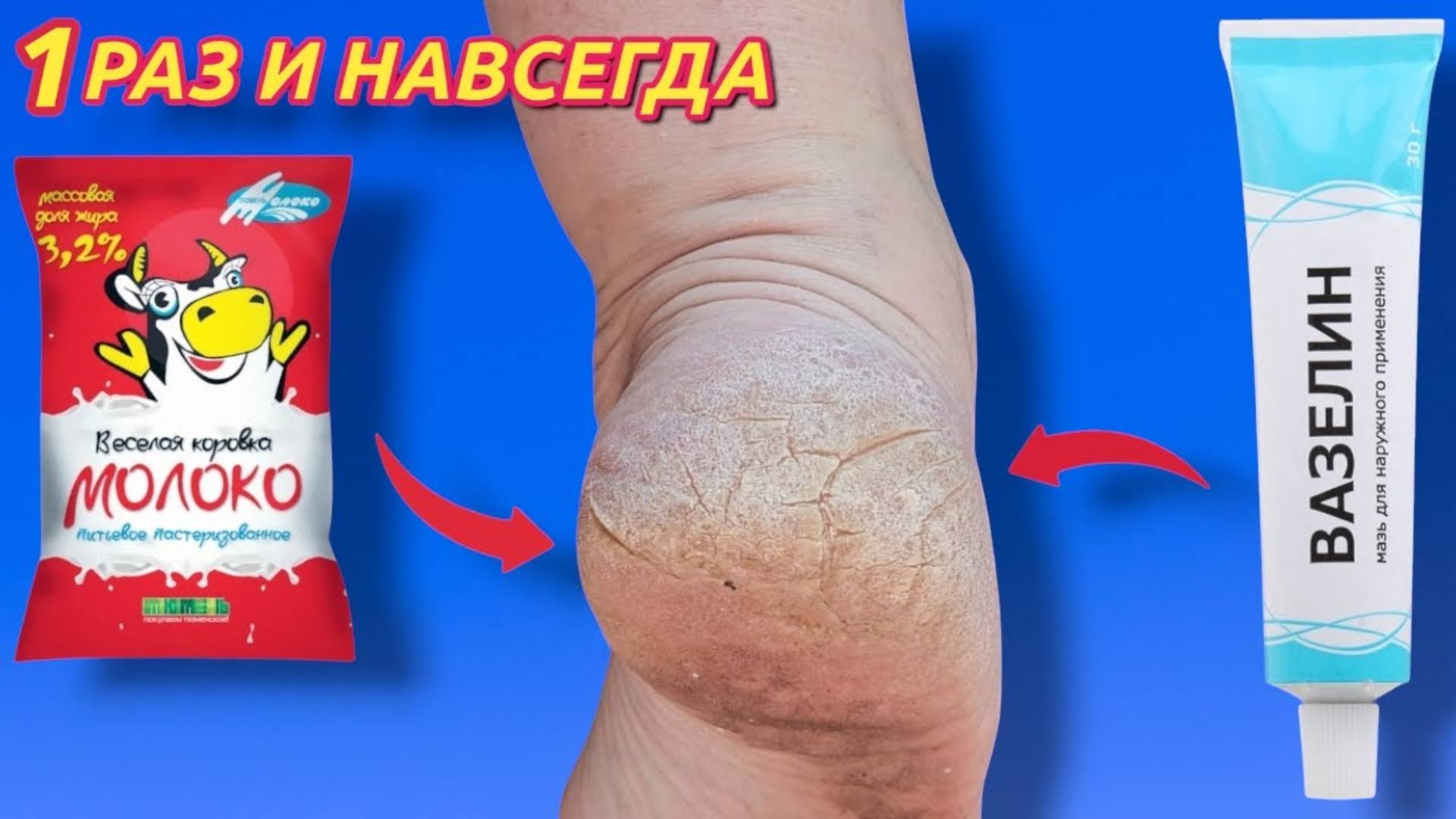 ВАЗЕЛИН И МОЛОКО избавит от трещин мозолей и грибка на ноге