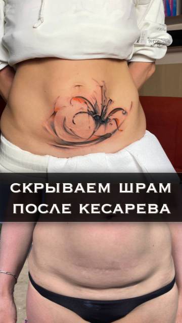 Скрытие шрама после кесарева !