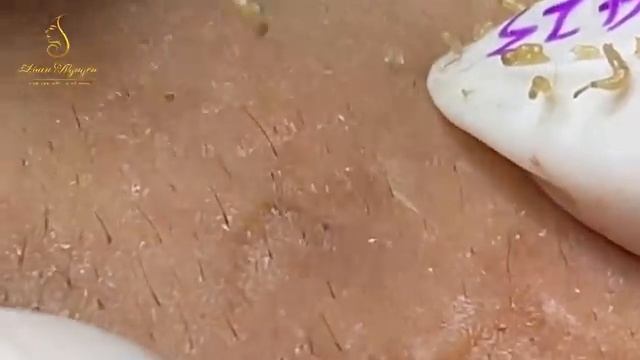 Косметолог убирает с лица угри и прыщи, глубокие черные точки, комедоны и акне.