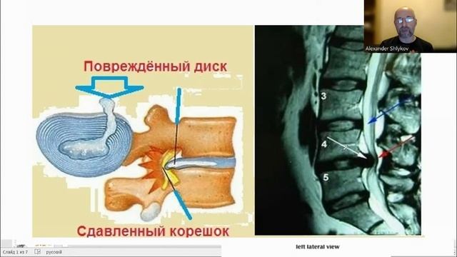 Физиологический ликбез. О грыжах и протрузиях