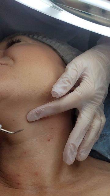 Удаление мелких паппиллом на коже шеи