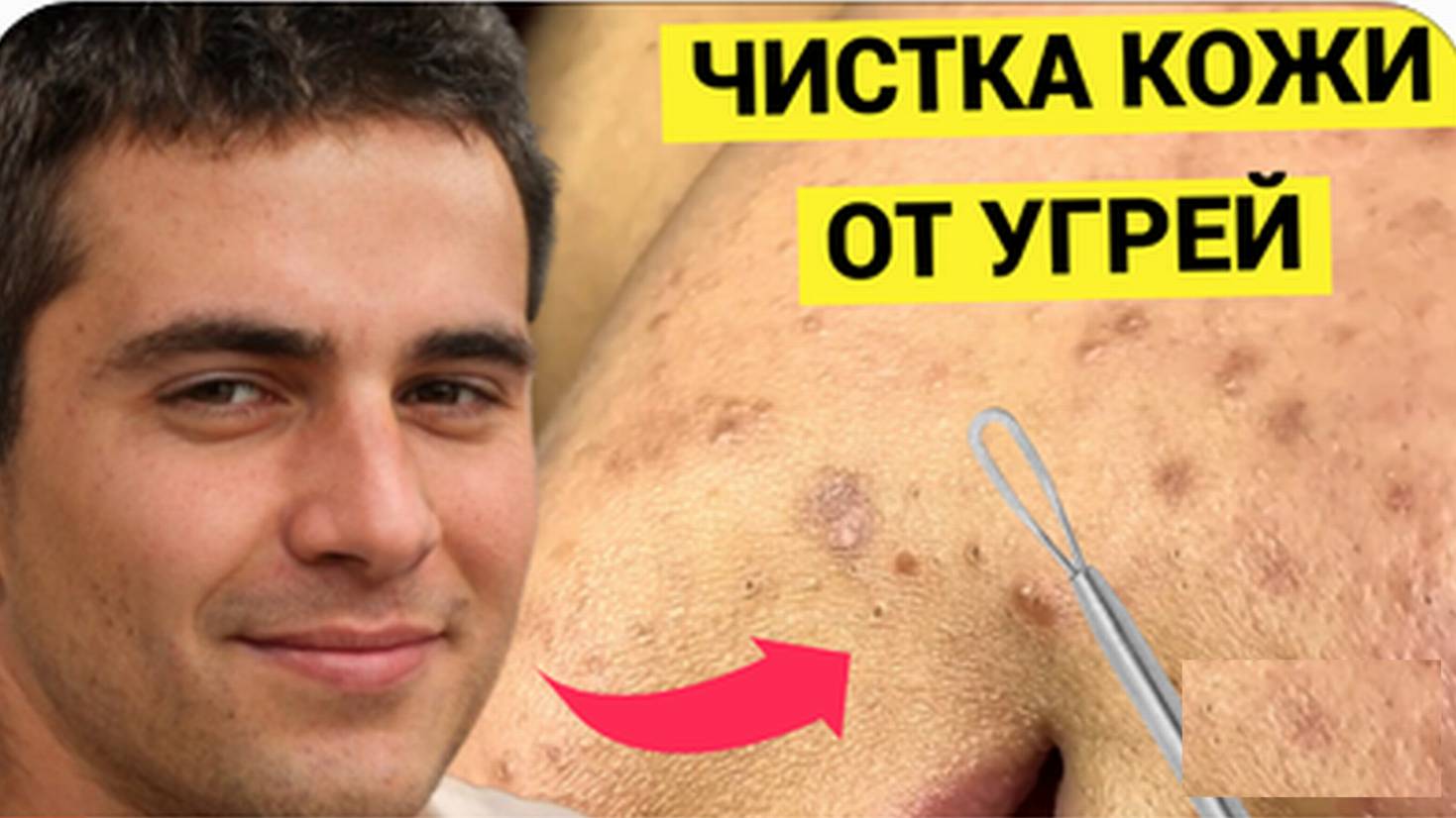 Избавиться от Желтых Комедонов и Прыщей помог парню толковый Косметолог. Повезло ему со специалистом