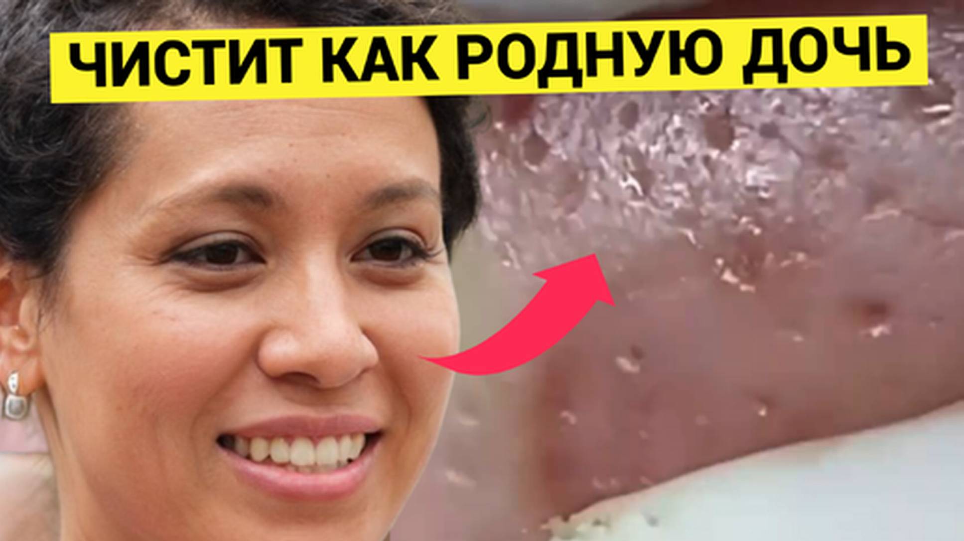 Мама ЗАБОТЛИВО Выдавливает Прыщи и Комедоны Родной Дочери. Может быть и такой Сюжет
