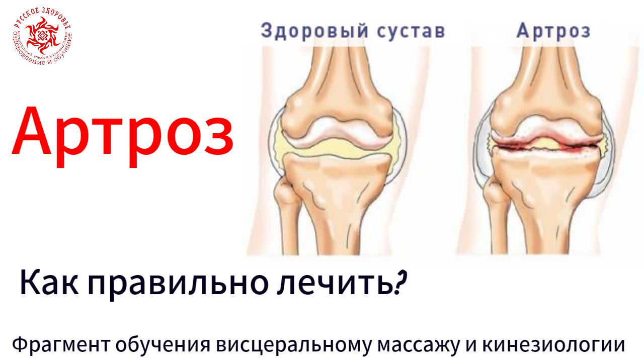 Артроз. Как правильно лечить? Фрагмент обучения висцеральному массажу и кинезиологии