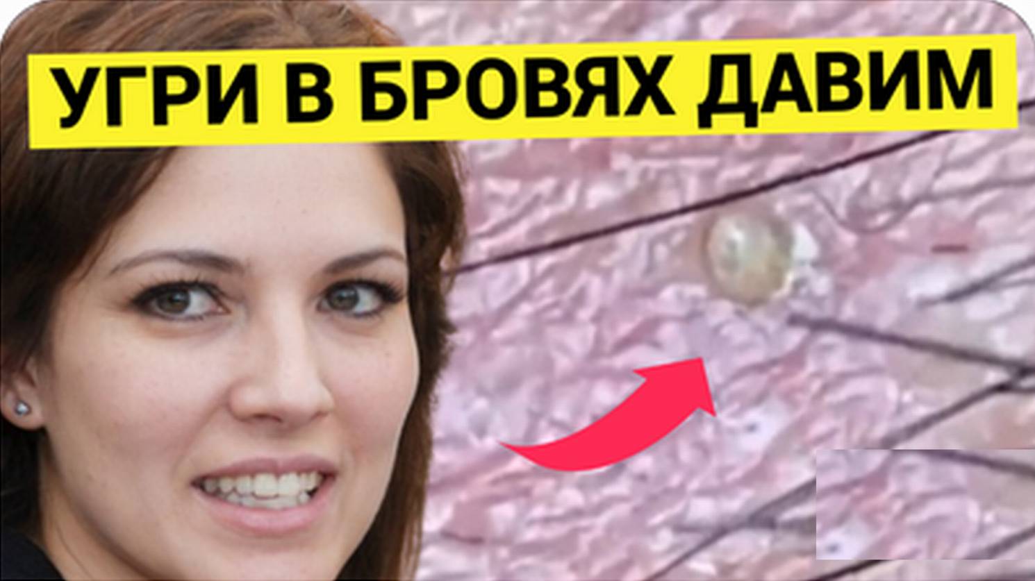 Много Комедонов в Бровях РАСПЛОДИЛОСЬ и на Висках. Косметолог как Грибник, собирает Урожай чётко, хо