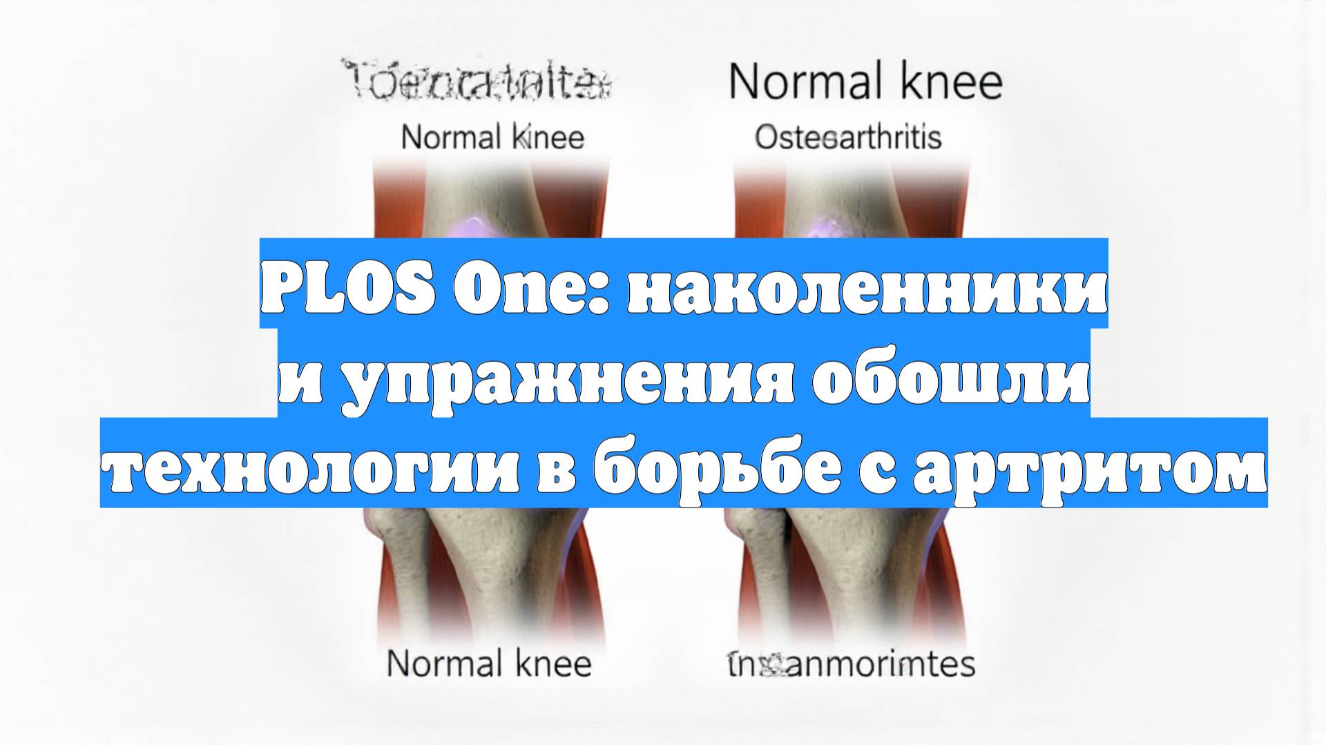 PLOS One: наколенники и упражнения обошли технологии в борьбе с артритом