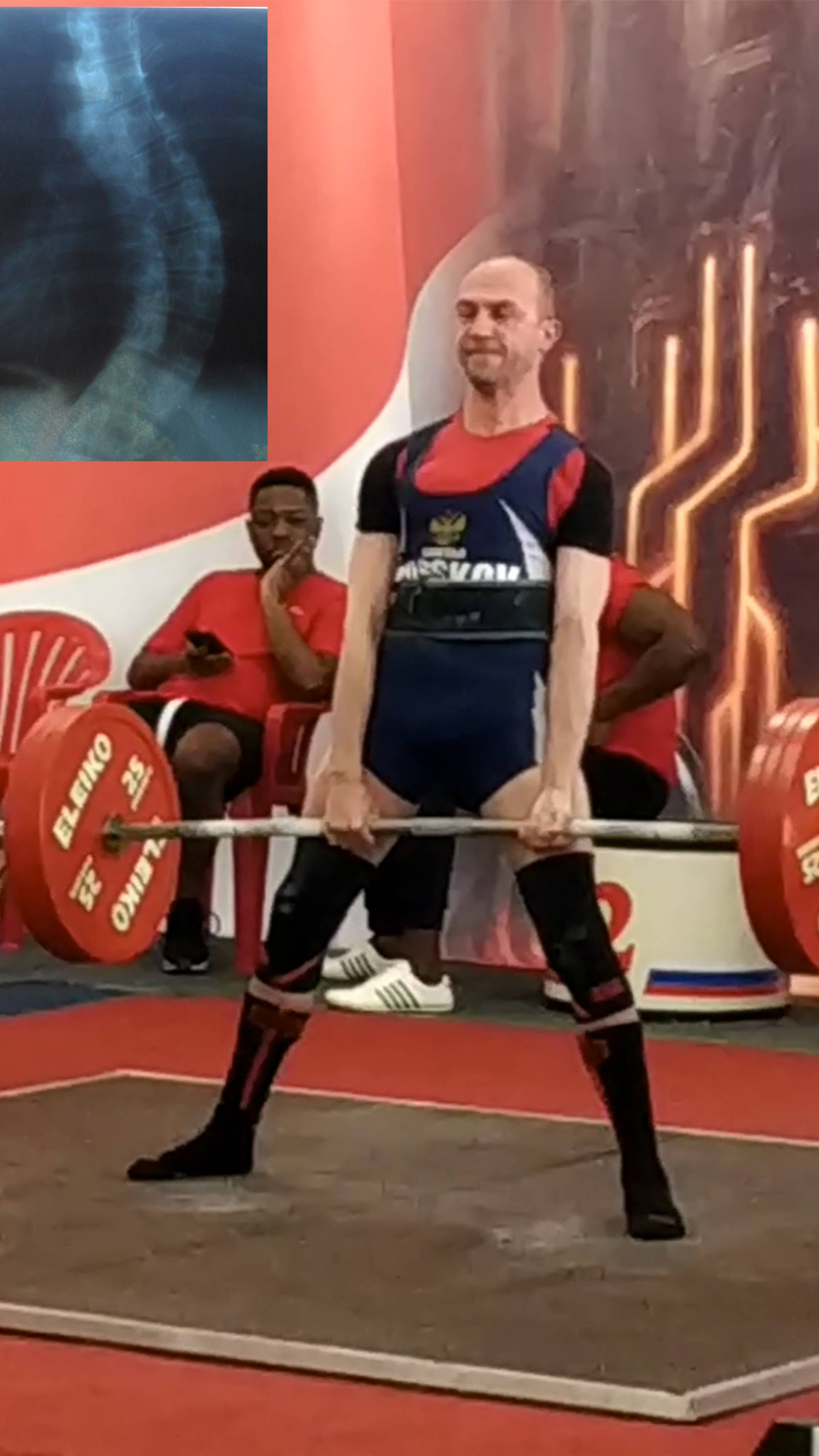 Сколиоз, здоровье и спорт