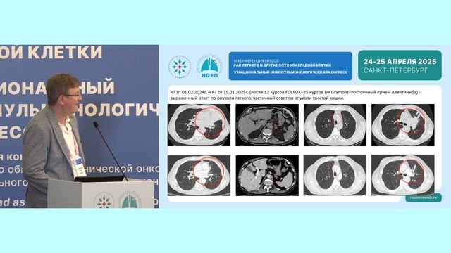 Разбор клинических случаев по раку легкого. Дискуссия с химиотерапевтом