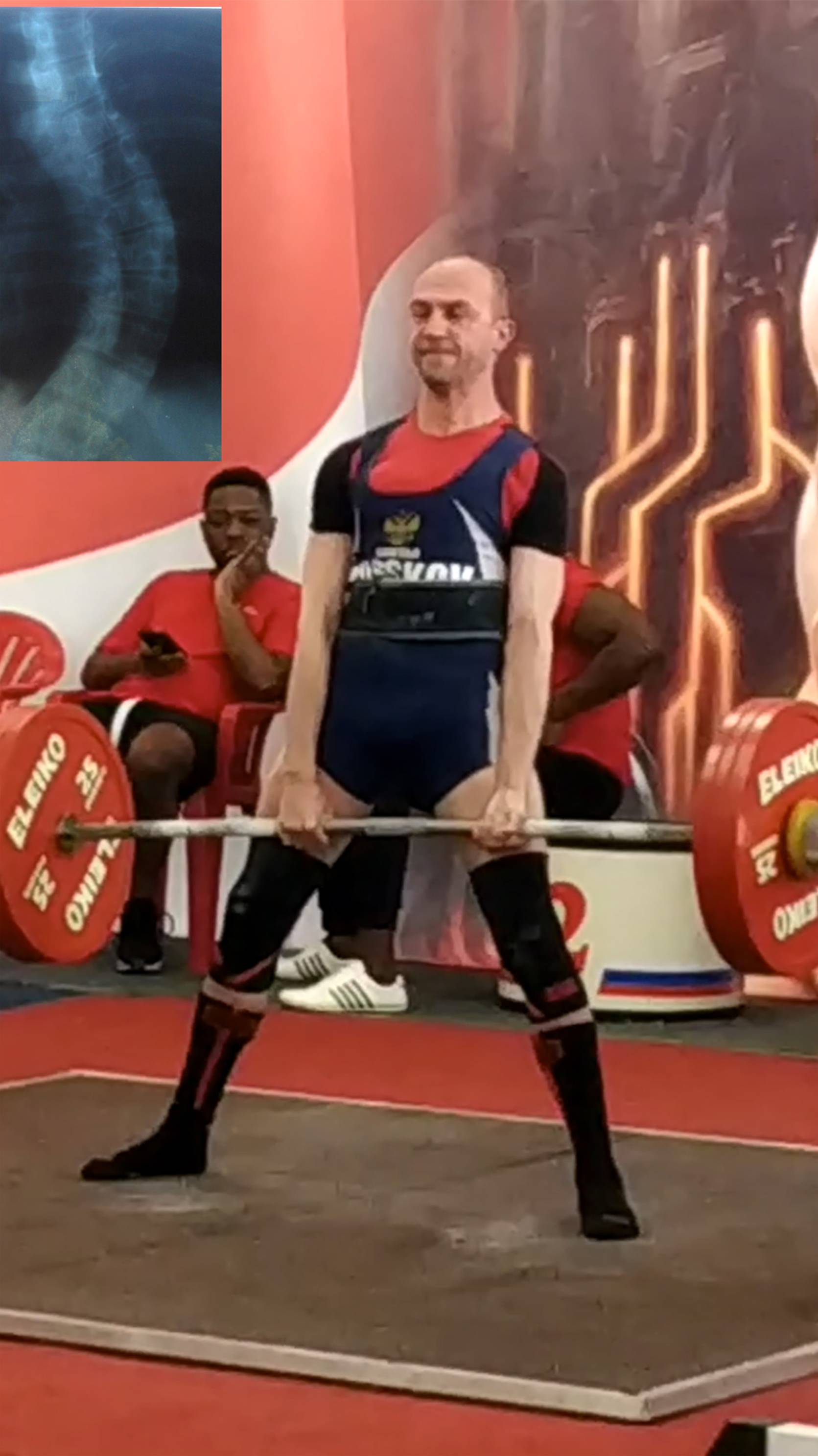 Сколиоз, здоровье и спорт.