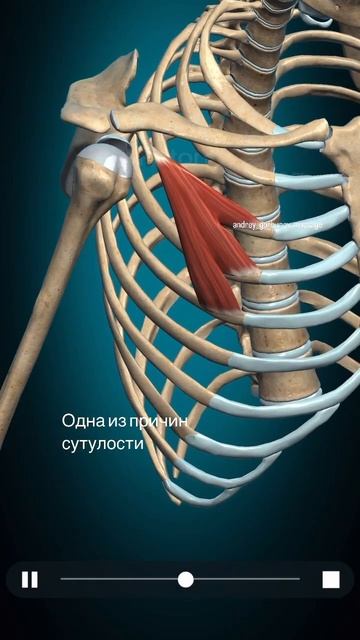 Сутулость и спазм в грудном отделе из-за этой мышцы