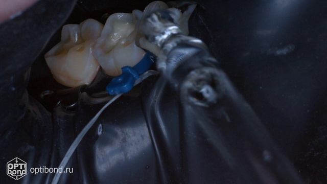 #Optibond aplication to occlusial surfaces of tooth 44, 45, 46, 47 #blackrubberdam #rubberdamology #