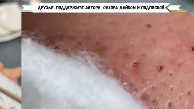 Девушка с НЕВЕРОЯТНЫМ Акне и Угрями Озадачила Косметолога. Прыщи и Черные Точки смешались на одной щ