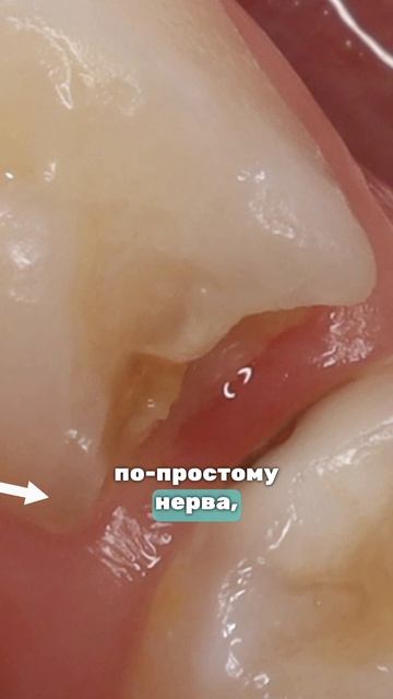Лечение пульпита🦷
