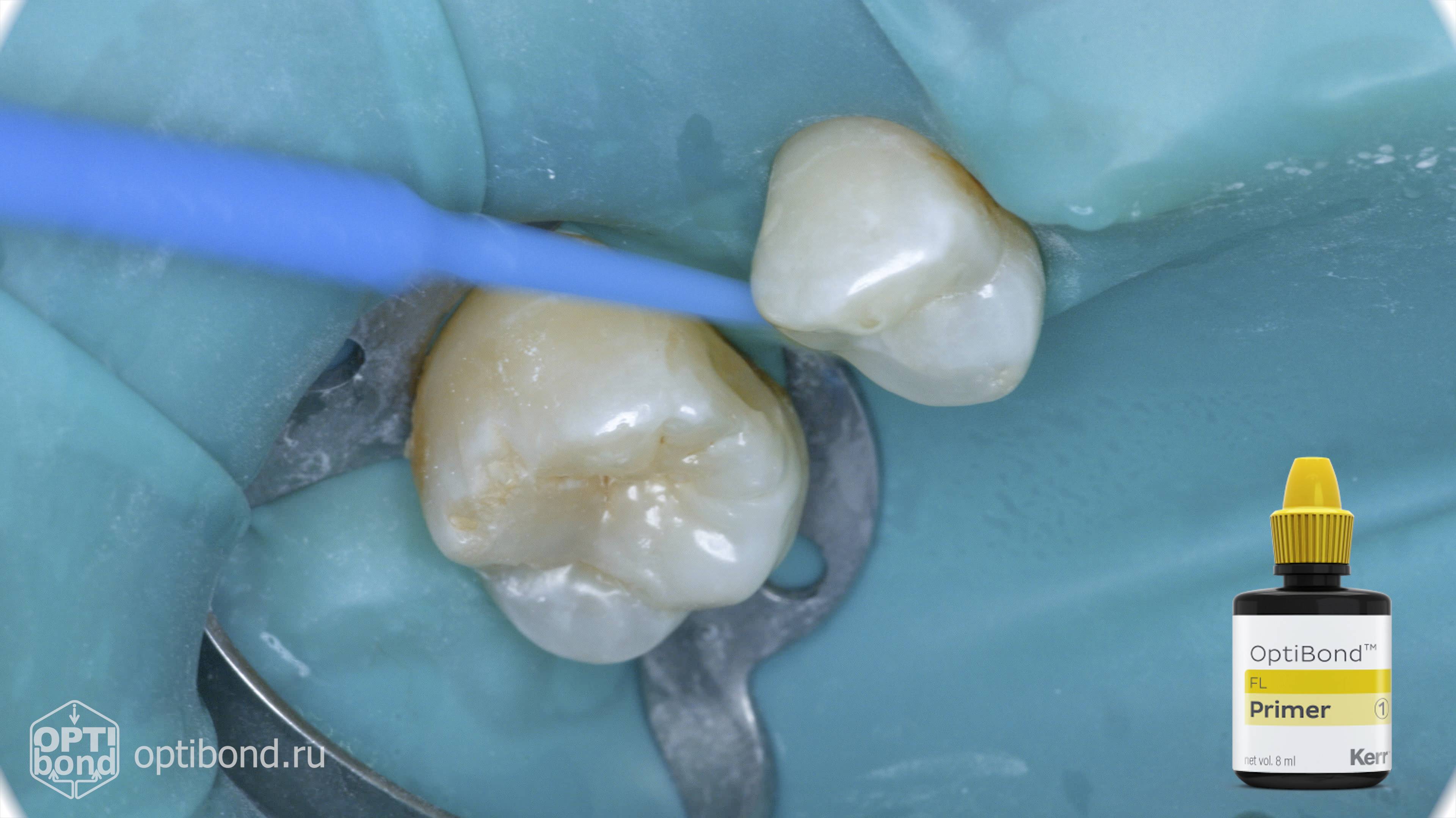 #Optibond application to occlusial surfaces of tooth  14, 15 #rubberdamology