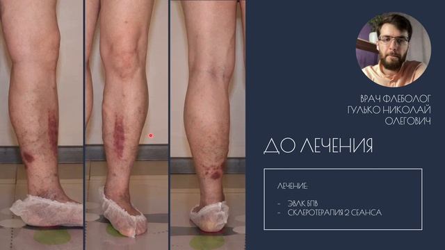 Варикоз привел к экземе, а могла быть язва. Как не допустить осложнений? Расскажет флеболог, Тюмень