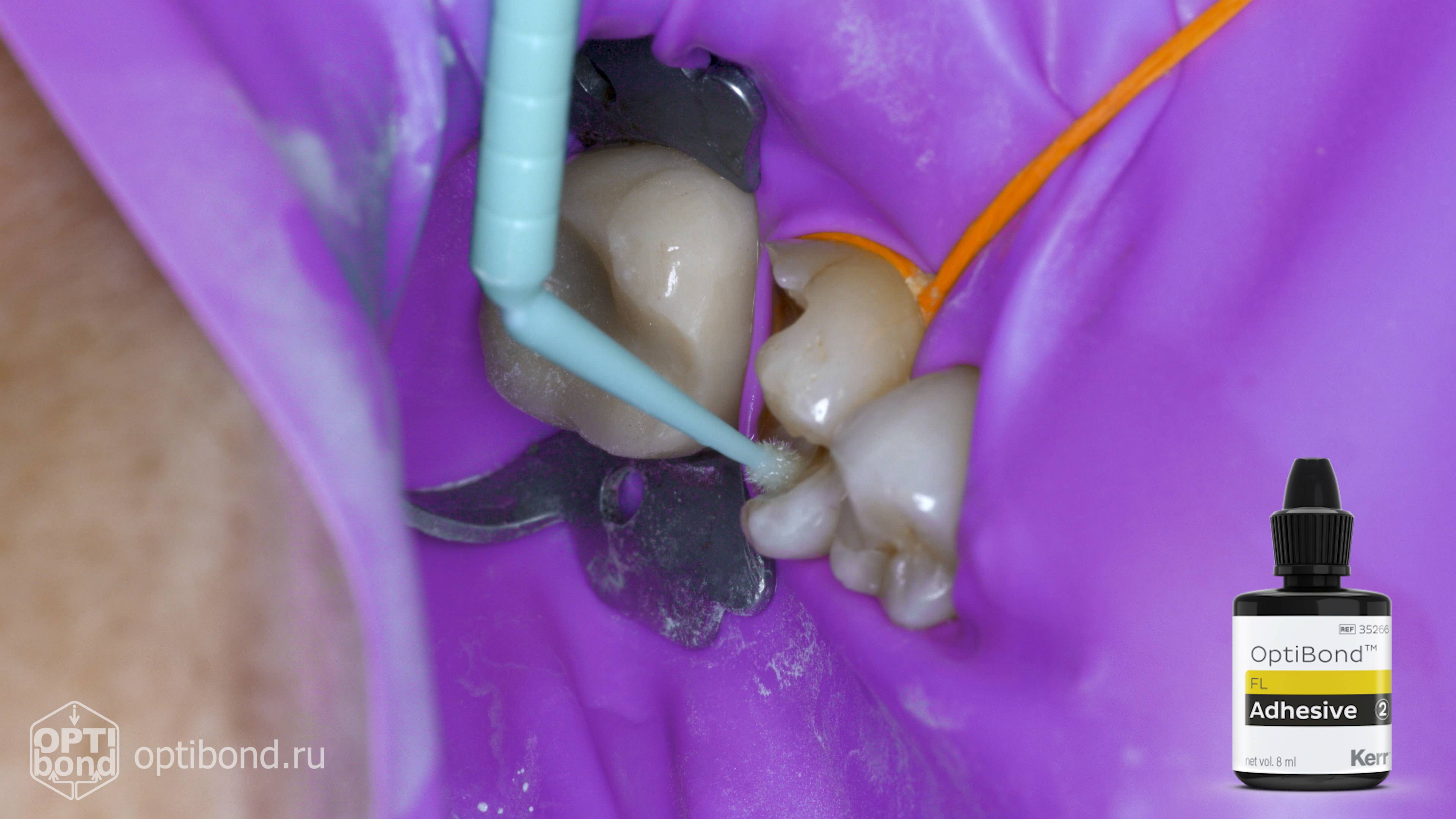 #Optibond application to occlusial surfaces of tooth  36 #purplerubberdam #rubberdamology
