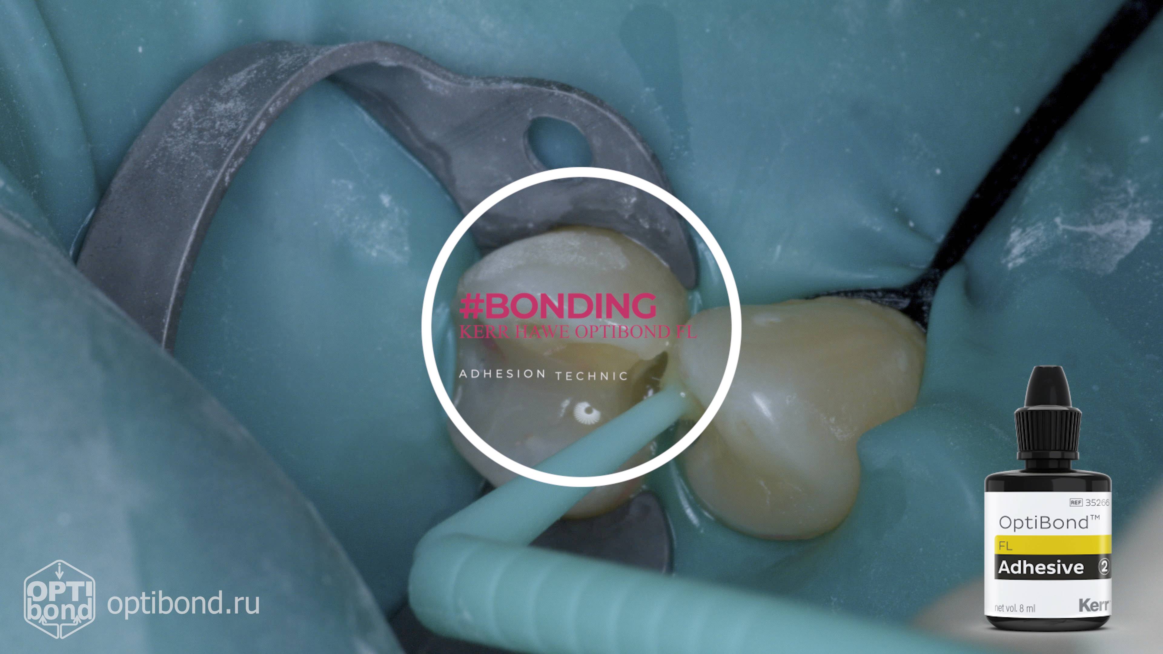 #Optibond application to occlusial surfaces of tooth  13, 14 #rubberdamology