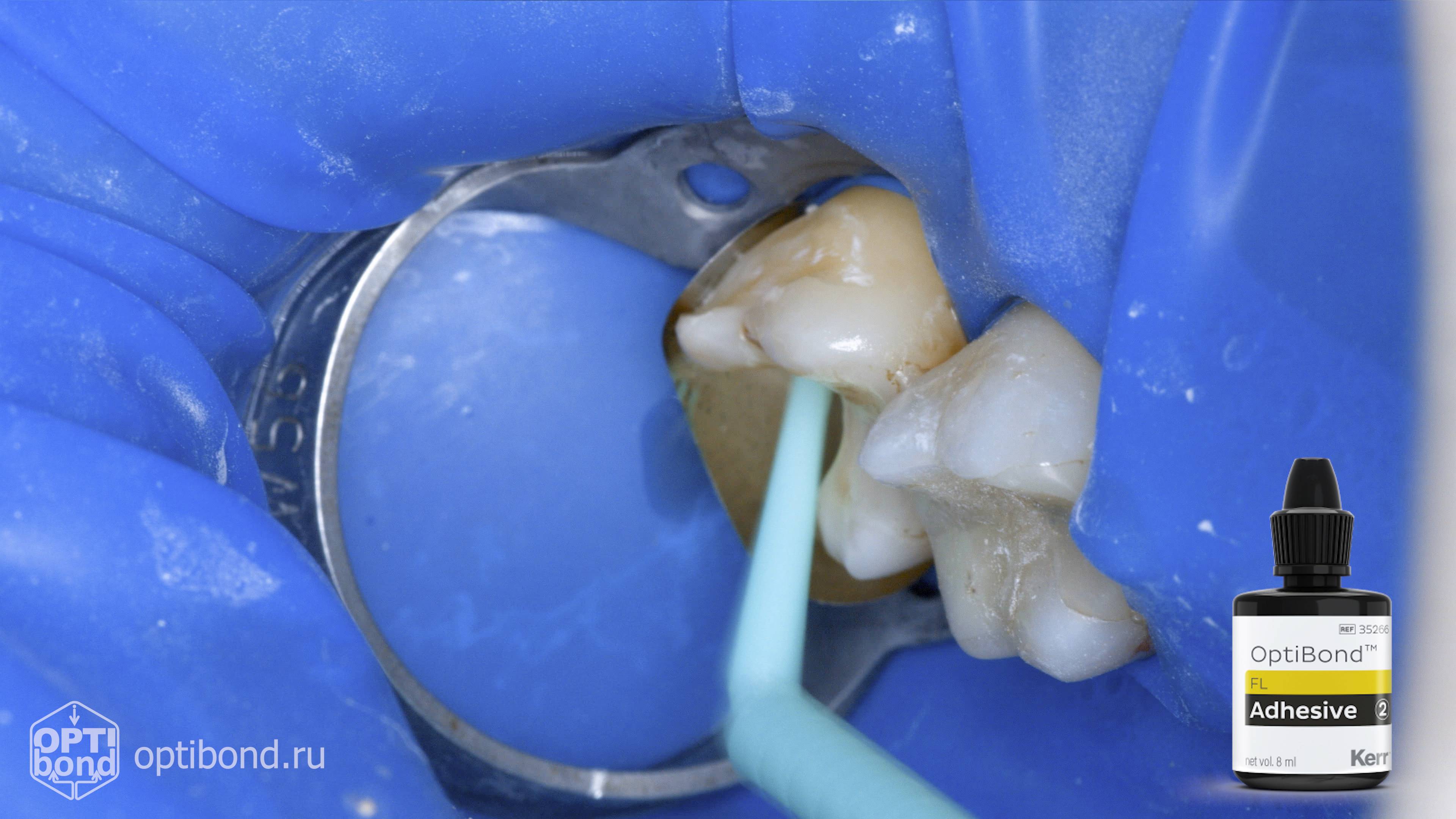 #Optibond application to occlusial surfaces of tooth  17 #purplerubberdam #rubberdamology