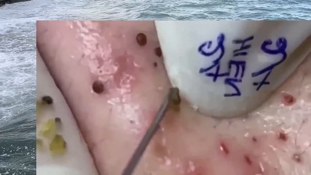 Прыщи и Комедоны как КРАТЕРЫ на Луне. Уникальный Гость. Попал в хорошие руки КОСМетолога. Выдавил вс